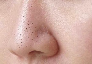 ⏪جوش‌های سرسیاه را با موثرترین راهکار‌ها محو کنید